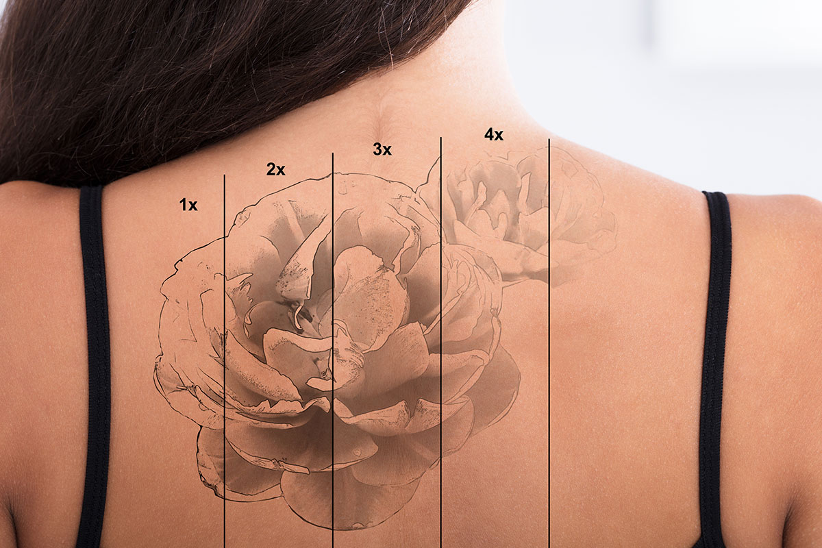 tattoo verwijderen